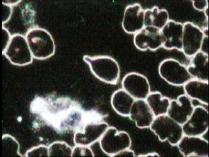 campo oscuro sangre y plasma patológico